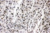 IHC staining of FFPE human glioma tissue with ZEB1 antibody. HIER: boil tissue sections in pH6, 10mM citrate buffer, for 20 min and allow to cool before testing.
