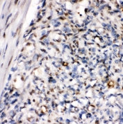 IHC staining of FFPE human melanoma tissue with ZEB1 antibody. HIER: boil tissue sections in pH6, 10mM citrate buffer, for 20 min and allow to cool before testing.