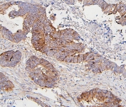 IHC staining of FFPE human colon cancer with CDK1 antibody. HIER: boil tissue sections in pH6, 10mM citrate buffer, for 20 min and allow to cool before testing.