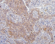 IHC staining of FFPE human lung cancer with CDK1 antibody. HIER: boil tissue sections in pH6, 10mM citrate buffer, for 20 min and allow to cool before testing.