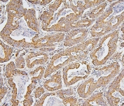 IHC staining of FFPE human intestinal cancer with BAK1 antibody. HIER: boil tissue sections in pH6, 10mM citrate buffer, for 20 min and allow to cool before testing.