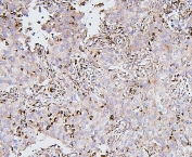 IHC staining of FFPE human lung cancer with BAK1 antibody. HIER: boil tissue sections in pH6, 10mM citrate buffer, for 20 min and allow to cool before testing.