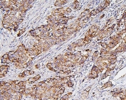IHC staining of FFPE human breast cancer with Hexokinase 1 antibody. HIER: boil tissue sections in pH8 EDTA for 20 min and allow to cool before testing.