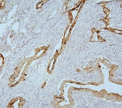 IHC staining of FFPE human intestinal cancer with MMP1 antibody. HIER: boil tissue sections in pH6, 10mM citrate buffer, for 20 min and allow to cool before testing.