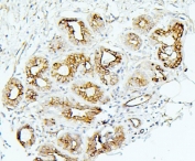IHC staining of FFPE human breast cancer with MMP1 antibody. HIER: boil tissue sections in pH6, 10mM citrate buffer, for 20 min and allow to cool before testing.