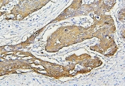 IHC staining of FFPE human esophagus squama cancer with Hsp27 antibody. HIER: boil tissue sections in pH6, 10mM citrate buffer, for 20 min and allow to cool before testing.