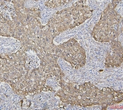 IHC staining of FFPE human lung cancer with Hsp27 antibody. HIER: boil tissue sections in pH6, 10mM citrate buffer, for 20 min and allow to cool before testing.
