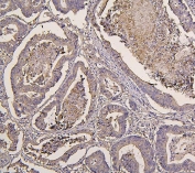 IHC staining of FFPE human colon cancer with IRS1 antibody. HIER: boil tissue sections in pH6, 10mM citrate buffer, for 20 min and allow to cool before testing.