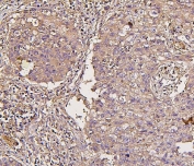 IHC staining of FFPE human lung cancer with IRS1 antibody. HIER: boil tissue sections in pH6, 10mM citrate buffer, for 20 min and allow to cool before testing.