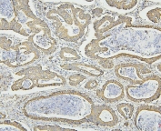IHC staining of FFPE human intestinal cancer with Hsp60 antibody. HIER: boil tissue sections in pH6, 10mM citrate buffer, for 20 min and allow to cool before testing.
