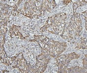 IHC staining of FFPE human lung cancer with Hsp60 antibody. HIER: boil tissue sections in pH6, 10mM citrate buffer, for 20 min and allow to cool before testing.