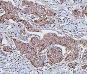 IHC staining of FFPE human breast cancer with Hsp60 antibody. HIER: boil tissue sections in pH6, 10mM citrate buffer, for 20 min and allow to cool before testing.