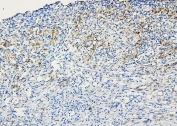 IHC staining of FFPE human melanoma with ABCB5 antibody. HIER: boil tissue sections in pH6, 10mM citrate buffer, for 20 min and allow to cool before testing.