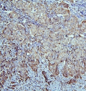 IHC staining of FFPE human breast cancer with ALDH1A1 antibody. HIER: boil tissue sections in pH6, 10mM citrate buffer, for 20 min and allow to cool before testing.