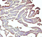 IHC staining of FFPE human renal cancer with ALDH1A1 antibody. HIER: boil tissue sections in pH6, 10mM citrate buffer, for 20 min and allow to cool before testing.