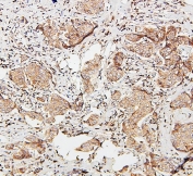 IHC staining of FFPE human breast cancer with SDHB antibody. HIER: boil tissue sections in pH6, 10mM citrate buffer, for 20 min and allow to cool before testing.