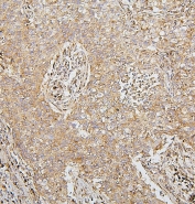 IHC staining of FFPE human lung cancer with SDHB antibody. HIER: boil tissue sections in pH6, 10mM citrate buffer, for 20 min and allow to cool before testing.