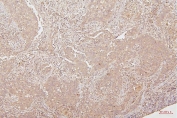 IHC staining of FFPE human lung cancer with HMGB1 antibody. HIER: boil tissue sections in pH6, 10mM citrate buffer, for 20 min and allow to cool before testing.