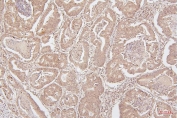 IHC staining of FFPE human intestinal cancer with HMGB1 antibody. HIER: boil tissue sections in pH6, 10mM citrate buffer, for 20 min and allow to cool before testing.