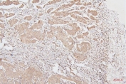 IHC staining of FFPE human breast cancer with HMGB1 antibody. HIER: boil tissue sections in pH6, 10mM citrate buffer, for 20 min and allow to cool before testing.