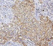 IHC staining of FFPE human lung cancer with SQSTM1 antibody. HIER: boil tissue sections in pH6, 10mM citrate buffer, for 20 min and allow to cool before testing.
