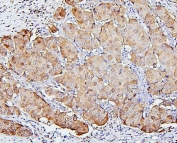 IHC staining of FFPE human breast cancer with SQSTM1 antibody. HIER: boil tissue sections in pH6, 10mM citrate buffer, for 20 min and allow to cool before testing.