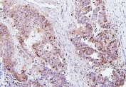 IHC staining of FFPE human colon cancer with SQSTM1 antibody. HIER: boil tissue sections in pH6, 10mM citrate buffer, for 20 min and allow to cool before testing.