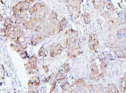 IHC staining of FFPE human breast cancer with EIF4G1 antibody. HIER: boil tissue sections in pH6, 10mM citrate buffer, for 20 min and allow to cool before testing.