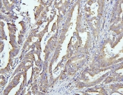 IHC staining of FFPE human intestinal cancer with EIF4G1 antibody. HIER: boil tissue sections in pH6, 10mM citrate buffer, for 20 min and allow to cool before testing.