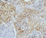 IHC staining of FFPE human lung cancer with EIF4G1 antibody. HIER: boil tissue sections in pH6, 10mM citrate buffer, for 20 min and allow to cool before testing.