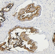 IHC staining of FFPE human prostate cancer with RAB27A antibody. HIER: boil tissue sections in pH6, 10mM citrate buffer, for 20 min and allow to cool before testing.