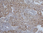 IHC staining of FFPE human lung cancer with Hsp105 Antibody antibody. HIER: boil tissue sections in pH6, 10mM citrate buffer, for 20 min and allow to cool before testing.