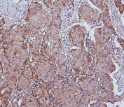 IHC staining of FFPE human breast cancer with Hsp105 Antibody antibody. HIER: boil tissue sections in pH6, 10mM citrate buffer, for 20 min and allow to cool before testing.