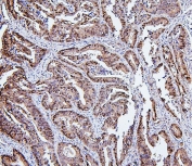 IHC staining of FFPE human intestinal cancer with Hsp105 Antibody antibody. HIER: boil tissue sections in pH6, 10mM citrate buffer, for 20 min and allow to cool before testing.