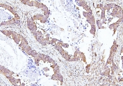 IHC staining of FFPE human colon cancer with EIF4A1/2/3 antibody. HIER: boil tissue sections in pH6, 10mM citrate buffer, for 20 min and allow to cool before testing.