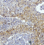 IHC staining of FFPE human lung cancer with EIF4A1/2/3 antibody. HIER: boil tissue sections in pH6, 10mM citrate buffer, for 20 min and allow to cool before testing.
