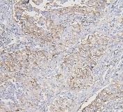 IHC staining of FFPE human lung cancer with COPE antibody. HIER: boil tissue sections in pH6, 10mM citrate buffer, for 20 min and allow to cool before testing.
