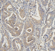 IHC staining of FFPE human intestinal cancer with COPE antibody. HIER: boil tissue sections in pH6, 10mM citrate buffer, for 20 min and allow to cool before testing.