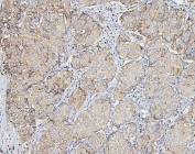 IHC staining of FFPE human breast cancer with COPE antibody. HIER: boil tissue sections in pH6, 10mM citrate buffer, for 20 min and allow to cool before testing.