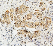 IHC staining of FFPE human breast cancer with SDHB antibody. HIER: boil tissue sections in pH6, 10mM citrate buffer, for 20 min and allow to cool before testing.