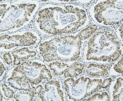 IHC staining of FFPE human rectal cancer with NRF1 antibody. HIER: boil tissue sections in pH6, 10mM citrate buffer, for 20 min and allow to cool before testing.