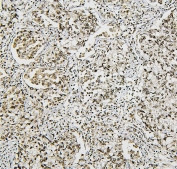 IHC staining of FFPE human lung cancer with NRF1 antibody. HIER: boil tissue sections in pH6, 10mM citrate buffer, for 20 min and allow to cool before testing.