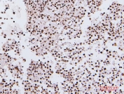 IHC staining of FFPE human testis cancer with NRF1 antibody. HIER: boil tissue sections in pH6, 10mM citrate buffer, for 20 min and allow to cool before testing.