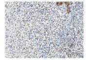 IHC staining of FFPE human gastric cancer with NRF1 antibody. HIER: boil tissue sections in pH8 EDTA for 20 min and allow to cool before testing.