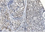 IHC staining of FFPE human melanoma with NRF1 antibody. HIER: boil tissue sections in pH8 EDTA for 20 min and allow to cool before testing.