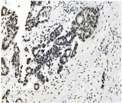 IHC staining of FFPE human ovarian cancer with NRF1 antibody. HIER: boil tissue sections in pH8 EDTA for 20 min and allow to cool before testing.