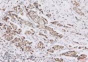 IHC staining of FFPE human breast cancer with NRF1 antibody. HIER: boil tissue sections in pH6, 10mM citrate buffer, for 20 min and allow to cool before testing.
