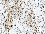 IHC staining of FFPE human renal carcinoma with NRF1 antibody. HIER: boil tissue sections in pH8 EDTA for 20 min and allow to cool before testing.