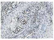 IHC staining of FFPE human bladder cancer with NRF1 antibody. HIER: boil tissue sections in pH8 EDTA for 20 min and allow to cool before testing.