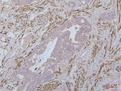 IHC staining of FFPE human colon cancer with Desmin antibody. HIER: boil tissue sections in pH6, 10mM citrate buffer, for 20 min and allow to cool before testing.